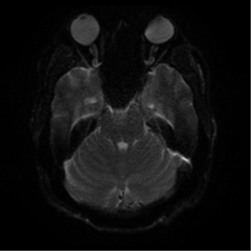 File:Cerebral abscess (Radiopaedia 57774-64740 Axial DWI 37).png