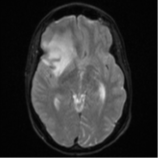 Cerebral abscess (Radiopaedia 60342-68009 Axial DWI 16).png