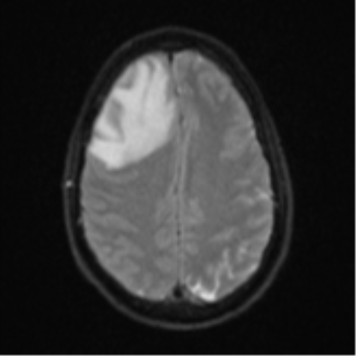 Cerebral abscess (Radiopaedia 60342-68009 Axial DWI 26).png