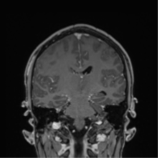 Cerebral abscess (Radiopaedia 60342-68009 H 21).png
