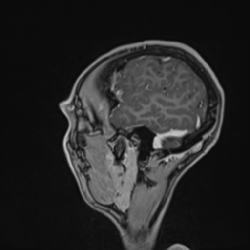 Cerebral abscess (Radiopaedia 60342-68009 J 12).png