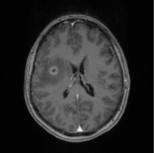 Cerebral abscess from pulmonary arteriovenous malformation (Radiopaedia 86275-102291 Axial T1 C+ 46).png