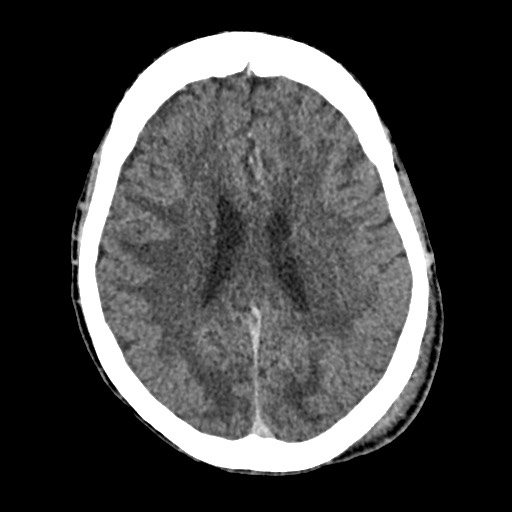 Cerebral amyloid angiopathy-related inflammation (Radiopaedia 74836-85848 Axial non-contrast 39).jpg
