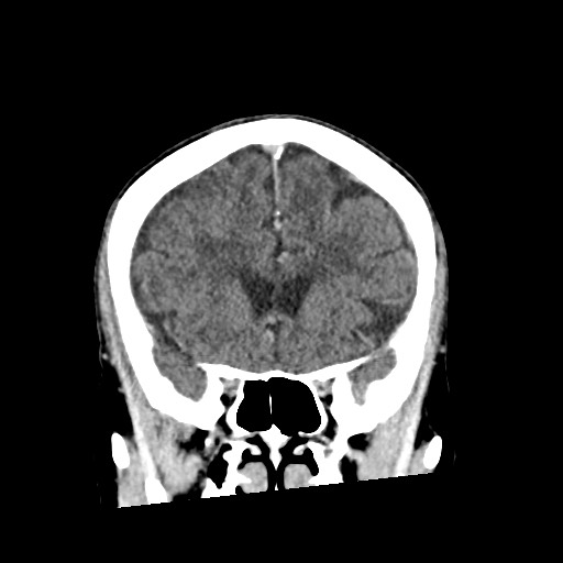 Cerebral amyloid angiopathy-related inflammation (Radiopaedia 74836-85848 Coronal non-contrast 25).jpg