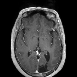 Cerebral amyloid angiopathy (Radiopaedia 29129-29518 Axial T1 C+ 74).jpg