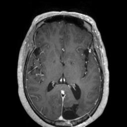 Cerebral amyloid angiopathy (Radiopaedia 29129-29518 Axial T1 C+ 78).jpg