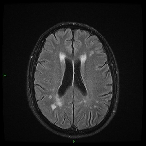 File:Cerebral amyloid angiopathy (Radiopaedia 77506-89664 Axial FLAIR 18).jpg