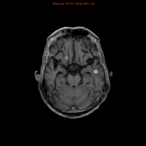 File:Cerebral and orbital tuberculomas (Radiopaedia 13308-13311 Axial T1 C+ 8).jpg