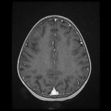 File:Cerebral and spinal tuberculosis (Radiopaedia 90489-107837 Axial T1 C+ 135).jpg