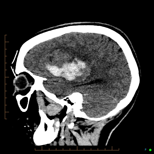 Cerebral arteriovenous malformation (AVM) (Radiopaedia 78162-90706 A 22).jpg