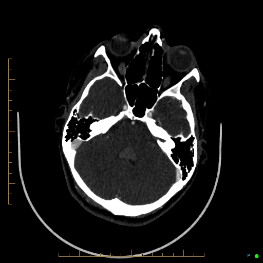 Cerebral arteriovenous malformation (AVM) (Radiopaedia 78162-90706 Axial CTA 88).jpg