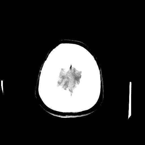 Cerebral arteriovenous malformation (Radiopaedia 28518-28759 Axial non-contrast 69).jpg