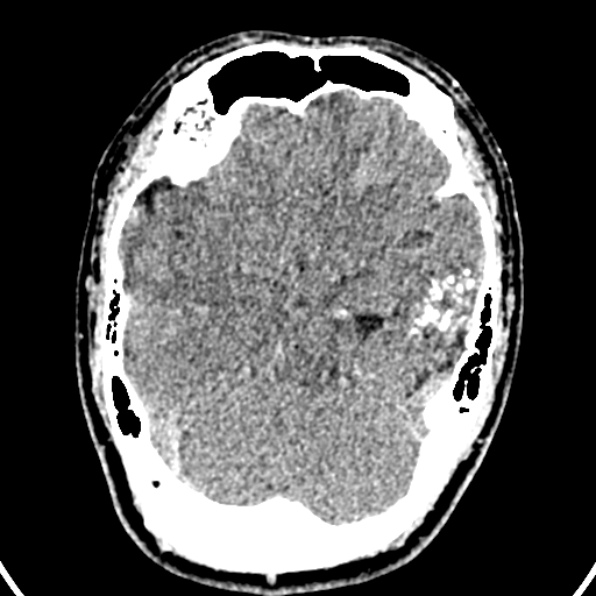 Cerebral arteriovenous malformation (Radiopaedia 37182-39012 Axial non-contrast 18).jpg