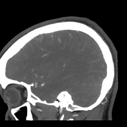 File:Cerebral arteriovenous malformation (Radiopaedia 39259-41505 Sagittal 18).png