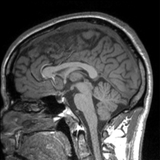 Cerebral arteriovenous malformation (Radiopaedia 39259-41506 Axial T1 79).png