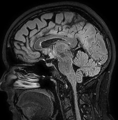 Cerebral arteriovenous malformation (Radiopaedia 74411-85654 Sagittal FLAIR 58).jpg