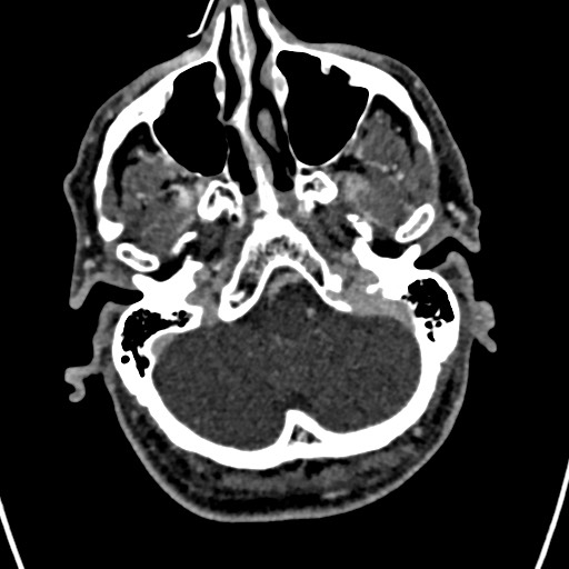 Cerebral arteriovenous malformation (Radiopaedia 78188-90746 Axial C+ delayed 28).jpg
