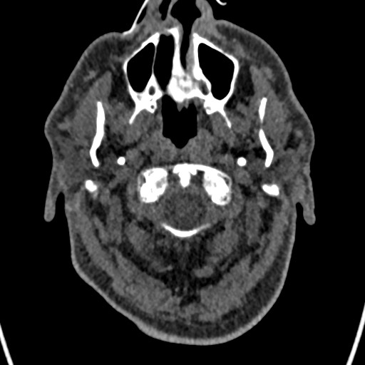 File:Cerebral arteriovenous malformation (Radiopaedia 78188-90746 Axial non-contrast 7).jpg