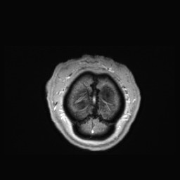 Cerebral arteriovenous malformation (Radiopaedia 84015-99245 Coronal T1 C+ 168).jpg