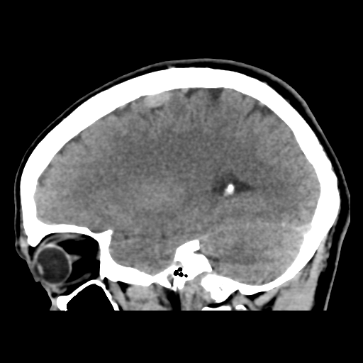 File:Cerebral arteriovenous malformation (Spetzler-Martin grade 2) (Radiopaedia 41262-44076 A 23).png