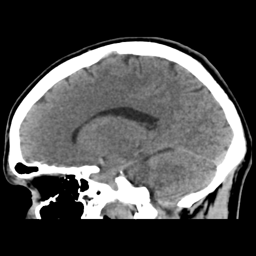 Cerebral arteriovenous malformation (Spetzler-Martin grade 2) (Radiopaedia 41262-44076 A 28).png