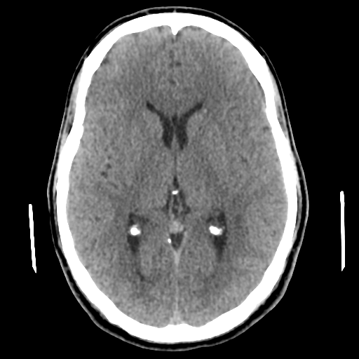 Cerebral arteriovenous malformation (Spetzler-Martin grade 2) (Radiopaedia 41262-44076 Axial non-contrast 29).png