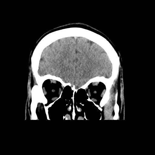 Cerebral arteriovenous malformation (Spetzler-Martin grade 2) (Radiopaedia 41262-44076 Coronal non-contrast 13).png