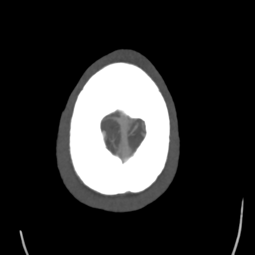Cerebral arteriovenous malformation (Spetzler-Martin grade 2) (Radiopaedia 41262-44076 E 51).png