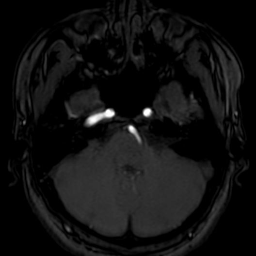Cerebral arteriovenous malformation at posterior body of corpus callosum (Radiopaedia 74111-84925 Axial MRA 40).jpg