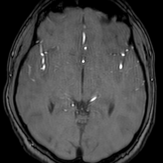 Cerebral arteriovenous malformation at posterior body of corpus callosum (Radiopaedia 74111-84925 Axial MRA 97).jpg