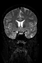 Cerebral arteriovenous malformation at posterior body of corpus callosum (Radiopaedia 74111-84925 Coronal T2 69).jpg