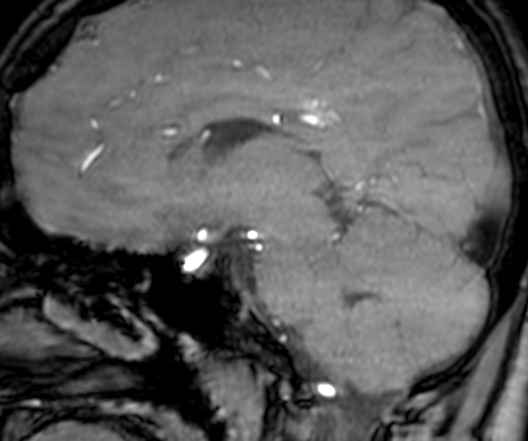 File:Cerebral arteriovenous malformation at posterior body of corpus callosum (Radiopaedia 74111-84925 J 175).jpg