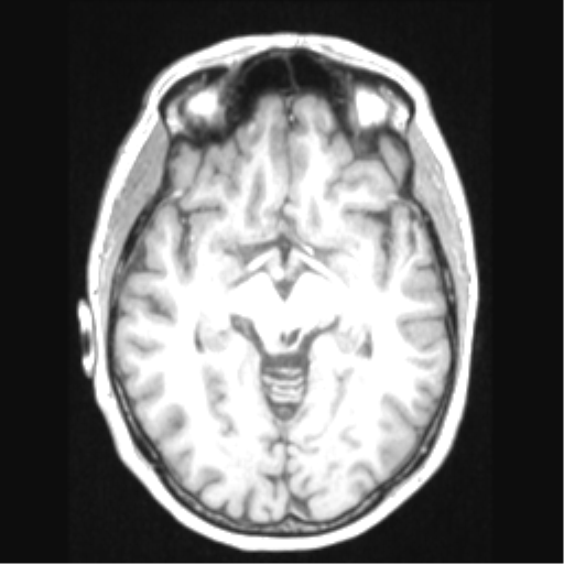 Cerebral arteriovenous malformation with hemorrhage (Radiopaedia 34422-35737 Axial T1 34).png