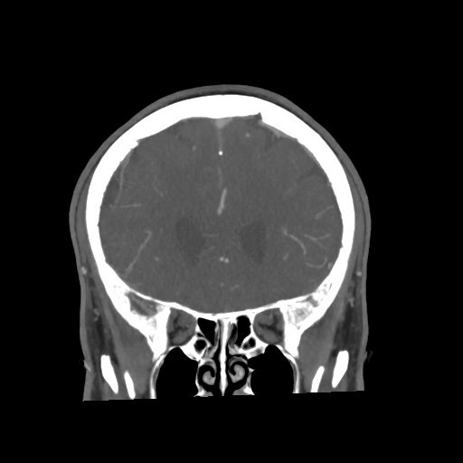 Cerebral arteriovenous malformation with lobar hemorrhage (Radiopaedia 35598-57216 C 29).jpg