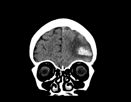Cerebral arteriovenous malformation with lobar hemorrhage (Radiopaedia 44725-48510 Coronal non-contrast 13).png