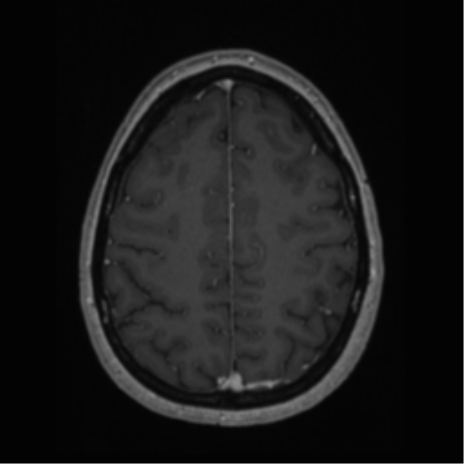 Cerebral cavernoma and development venous anomaly (Radiopaedia 37603-39482 Axial T1 C+ 57).png