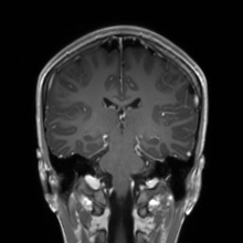 Cerebral cavernous venous malformation (Radiopaedia 70008-80021 Coronal T1 C+ 27).jpg