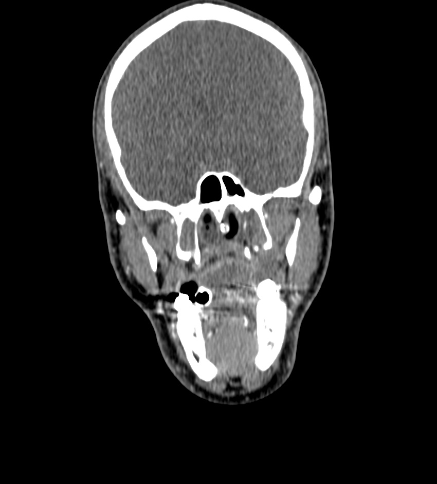 Cerebral edema in an overdose patient (Radiopaedia 72005-82539 B 5).jpg