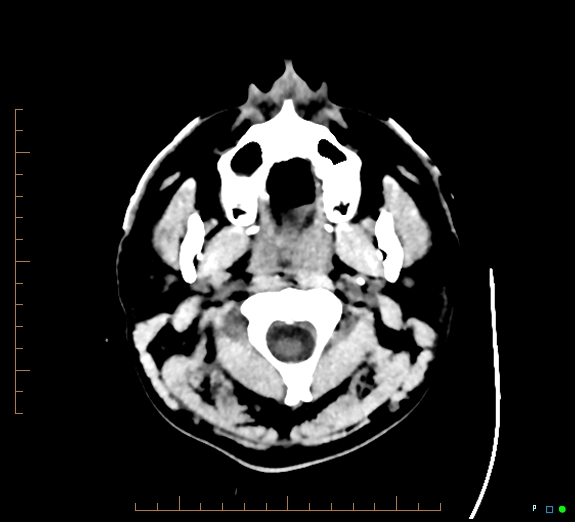 Cerebral fat embolism (Radiopaedia 85521-101220 Axial non-contrast 4).jpg
