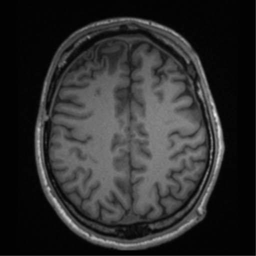 Cerebral hemorrhagic contusions- temporal evolution (Radiopaedia 40224-42757 Axial T1 56).png