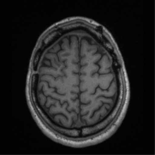 Cerebral hemorrhagic contusions- temporal evolution (Radiopaedia 40224-42757 Axial T1 63).png