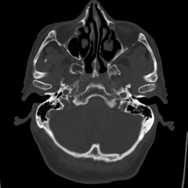 Cerebral hemorrhagic contusions (Radiopaedia 23145-23188 Axial bone window 9).jpg