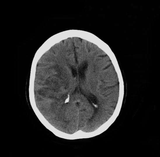 File:Cerebral infarction vs glioblastoma (Radiopaedia 10136-10676 Axial non-contrast 1).jpeg