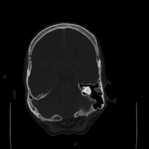 Cerebral metastases - breast primary (Radiopaedia 77653-89857 Axial bone window 39).jpg