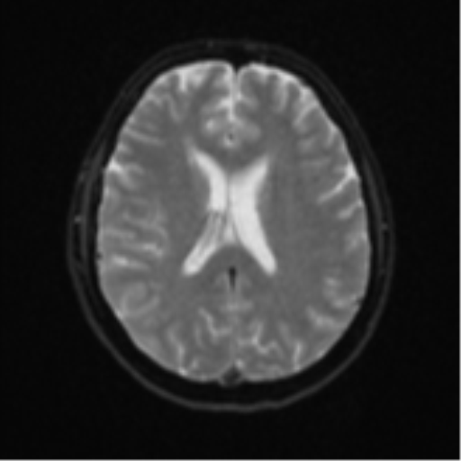 Cerebral metastases mimicking abscesses (Radiopaedia 45841-50131 Axial DWI 18).png