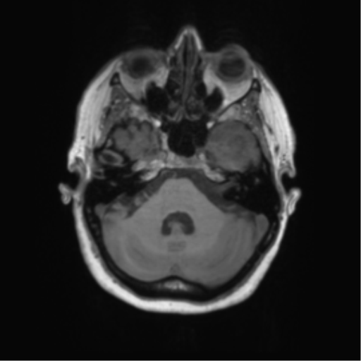 Cerebral metastasis mimicking glioblastoma (Radiopaedia 69155-78937 Axial T1 12).png