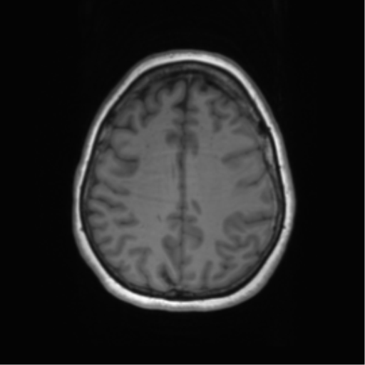Cerebral metastasis mimicking glioblastoma (Radiopaedia 69155-78937 Axial T1 49).png