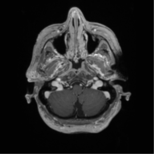 Cerebral metastasis to basal ganglia (Radiopaedia 81568-95413 Axial T1 C+ 9).png