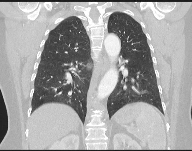 Cerebral metastasis to basal ganglia (Radiopaedia 81568-95414 Coronal lung window 57).png