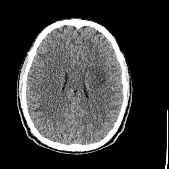 Cerebral toxoplasmosis (Radiopaedia 53993-60131 Axial non-contrast 51).jpg